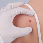 Mole Removal Treatment Timeline Explained