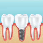 Eating with Dental Implants: Foods You Can Enjoy Again